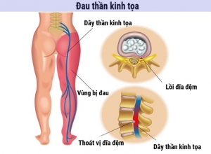 Đau Thần Kinh Tọa Nguyên Nhân Do Đâu? Mức Độ Nguy Hiểm Và Triệu Chứng Của Bệnh